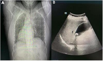 Laparoscopic Cholecystectomy in a Patient With Situs Inversus Totalis Presenting With Cholelithiasis: A Case Report